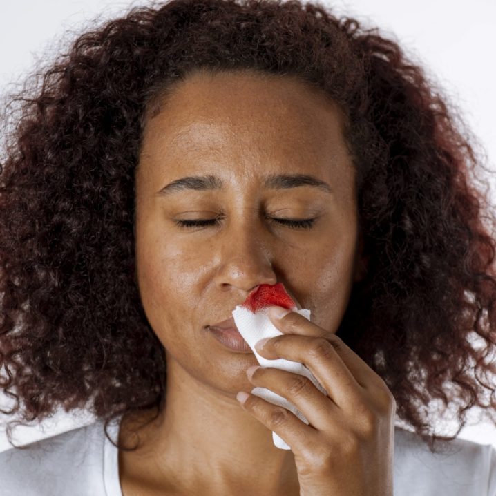 I've Had Severe Nosebleeds For Over 20 Years - Here Are 4 Ways I Put a ...